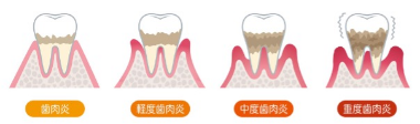 歯周病の治療について