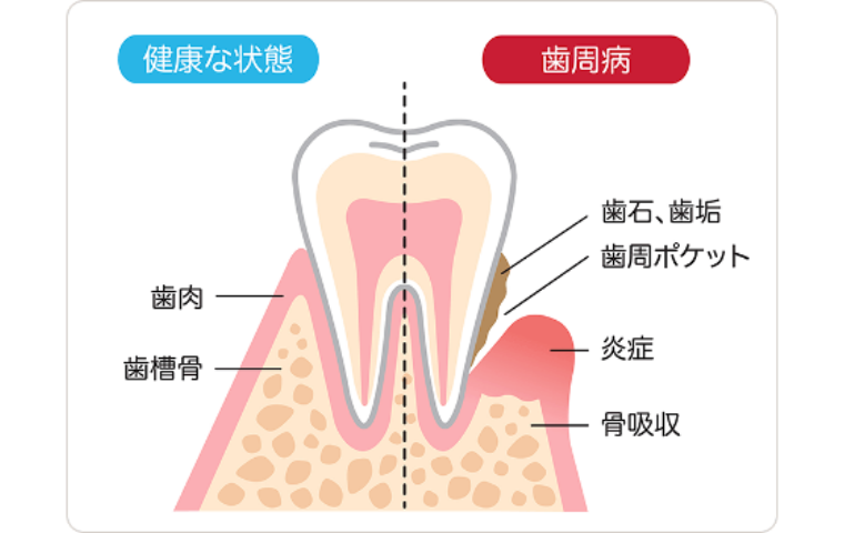 セラミック治療とは